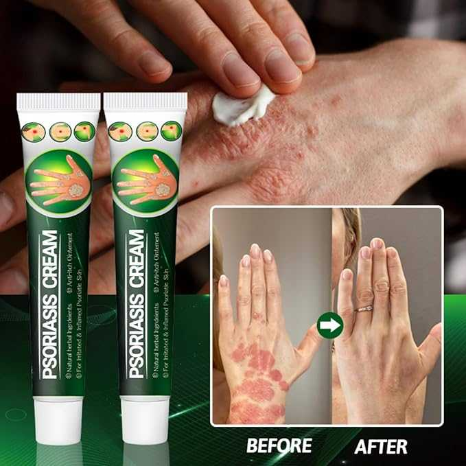 Psoriasis Cream - Herbal Plant Extracts